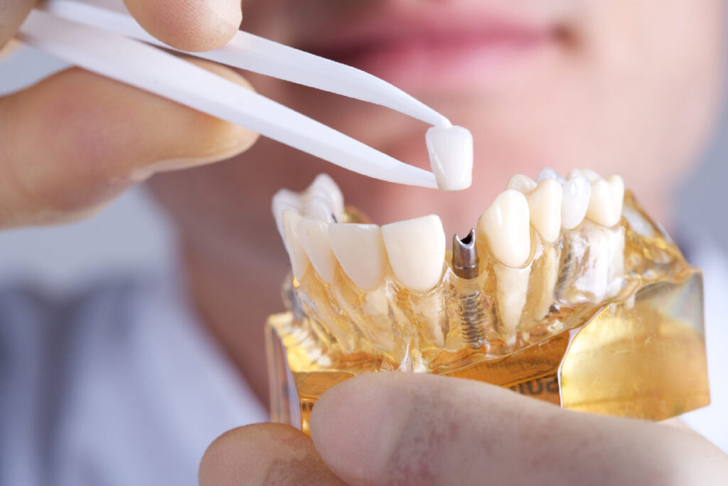 ¿Qué son y para qué sirven las coronas dentales?