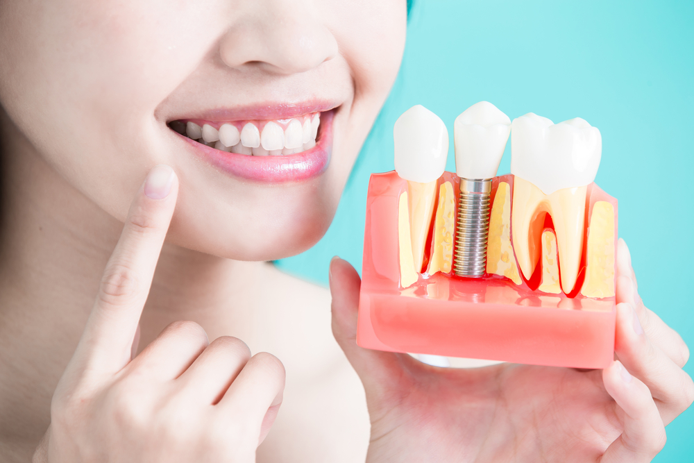 Diferencias entre las carillas y las coronas dentales