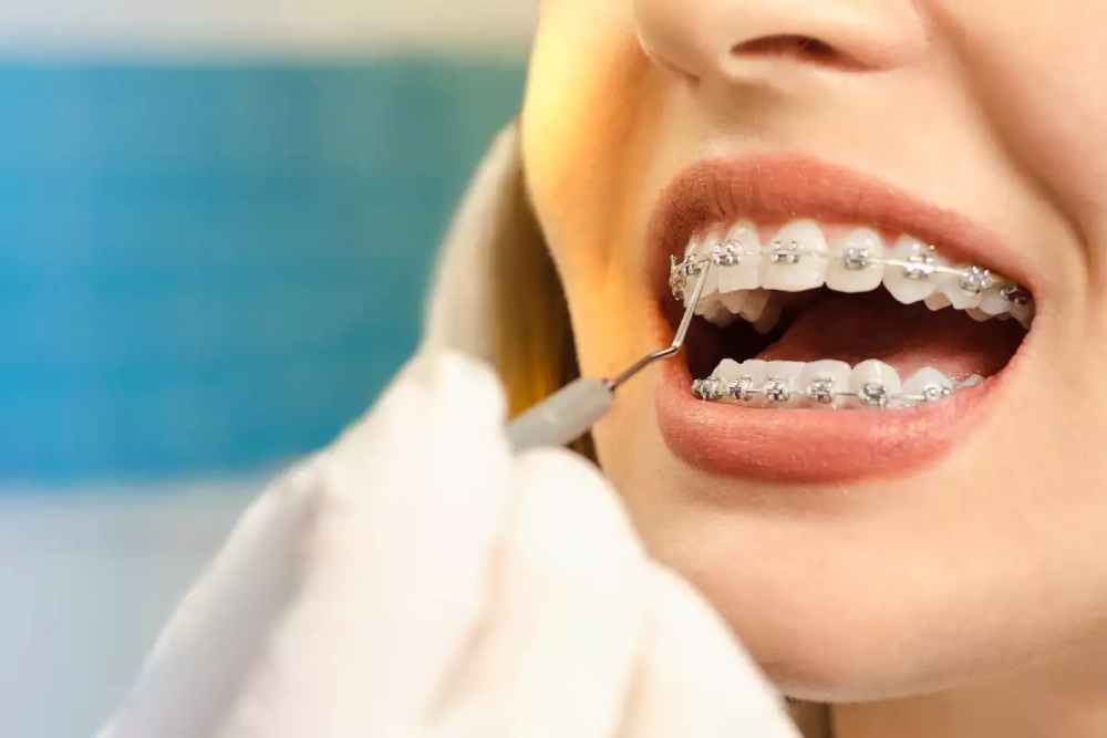 ¿Necesitas realizarte una ortodoncia? Te explicamos todo sobre este tratamiento